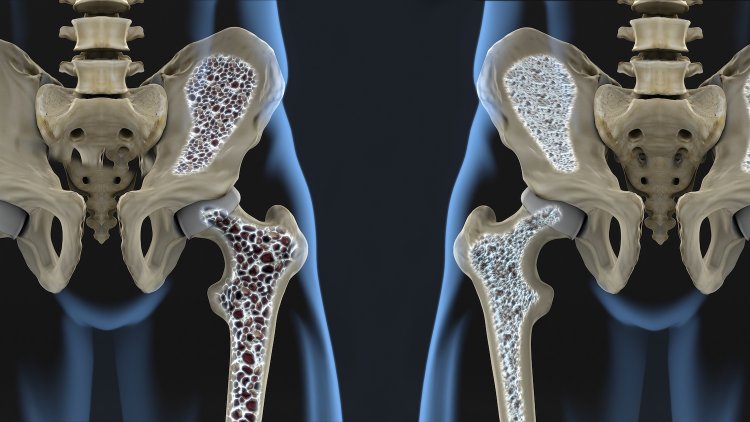 Por que a osteoporose é uma doença silenciosa?