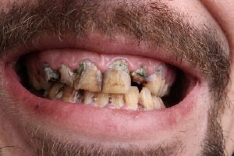 Dia Mundial sem Tabaco: dentes escurecidos, cárie, periodontite, mau hálito e câncer são alguns dos danos do cigarro para a saúde bucal